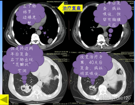 小细胞肺癌的临床CT病理特点及其征象分析