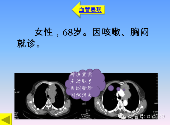 小细胞肺癌的临床CT病理特点及其征象分析