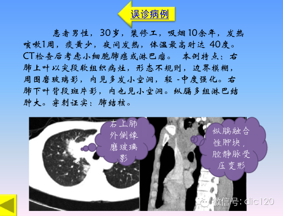 小细胞肺癌的临床CT病理特点及其征象分析