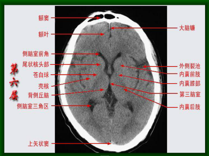 头颅CT断层解剖图片