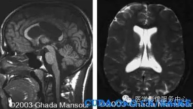 第五脑室、第六脑室以及中间帆腔(图文详解) 第五脑室、第六脑室以及中间帆腔(图文详解)