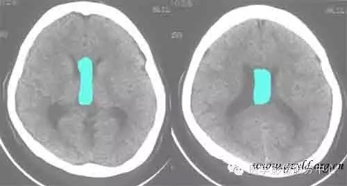第五脑室、第六脑室以及中间帆腔(图文详解) 第五脑室、第六脑室以及中间帆腔(图文详解)