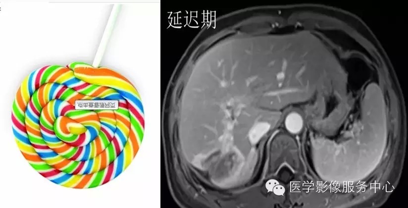 肝脏肿瘤的典型征象—棒棒糖征 肝脏肿瘤的典型征象—棒棒糖征
