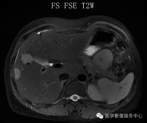 肝脏肿瘤的典型征象—棒棒糖征 肝脏肿瘤的典型征象—棒棒糖征