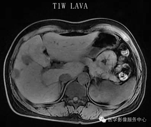 肝脏肿瘤的典型征象—棒棒糖征 肝脏肿瘤的典型征象—棒棒糖征