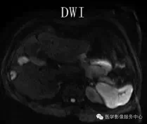 肝脏肿瘤的典型征象—棒棒糖征 肝脏肿瘤的典型征象—棒棒糖征