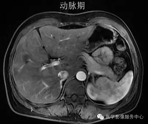 肝脏肿瘤的典型征象—棒棒糖征 肝脏肿瘤的典型征象—棒棒糖征