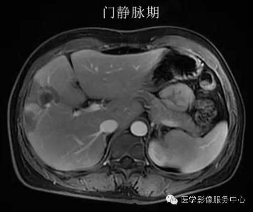 肝脏肿瘤的典型征象—棒棒糖征 肝脏肿瘤的典型征象—棒棒糖征