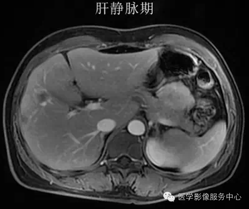 肝脏肿瘤的典型征象—棒棒糖征 肝脏肿瘤的典型征象—棒棒糖征