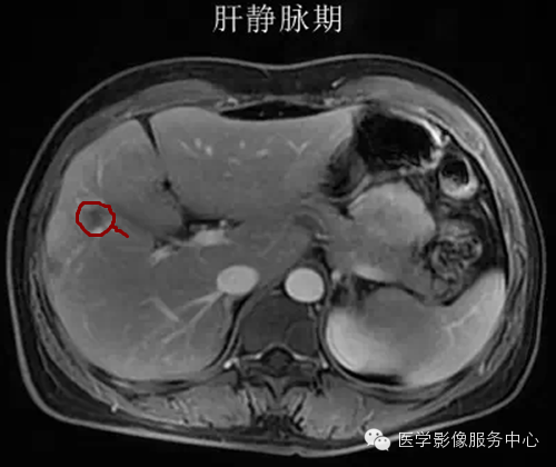 肝脏肿瘤的典型征象—棒棒糖征 肝脏肿瘤的典型征象—棒棒糖征