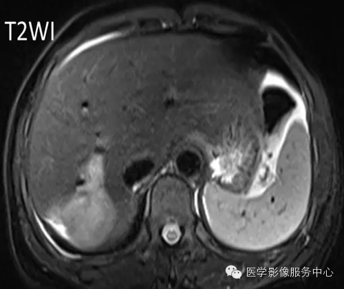 肝脏肿瘤的典型征象—棒棒糖征 肝脏肿瘤的典型征象—棒棒糖征