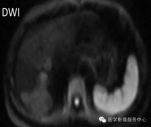 肝脏肿瘤的典型征象—棒棒糖征 肝脏肿瘤的典型征象—棒棒糖征