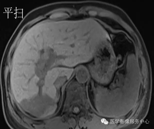 肝脏肿瘤的典型征象—棒棒糖征 肝脏肿瘤的典型征象—棒棒糖征