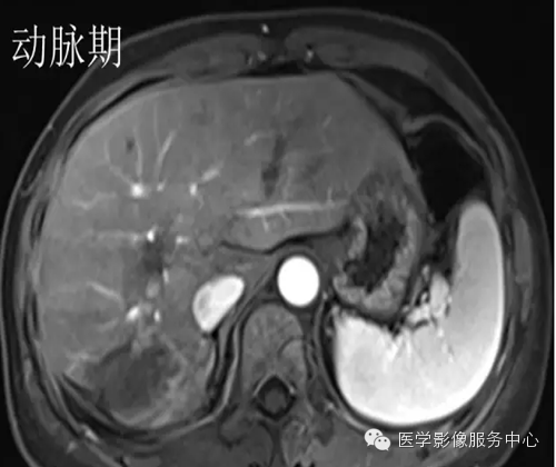 肝脏肿瘤的典型征象—棒棒糖征 肝脏肿瘤的典型征象—棒棒糖征