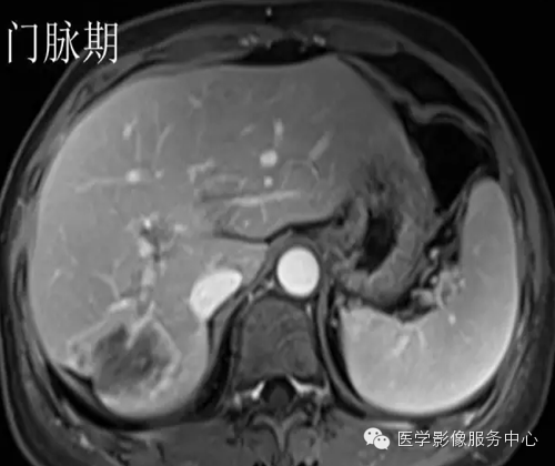 肝脏肿瘤的典型征象—棒棒糖征 肝脏肿瘤的典型征象—棒棒糖征
