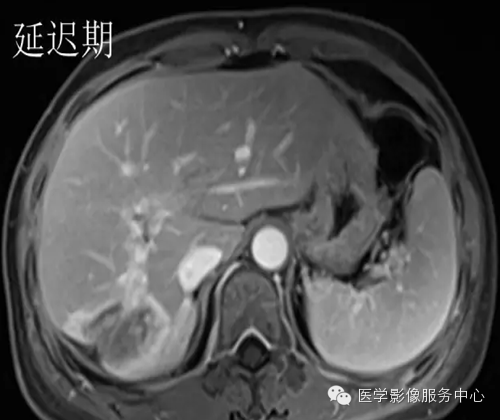 肝脏肿瘤的典型征象—棒棒糖征 肝脏肿瘤的典型征象—棒棒糖征