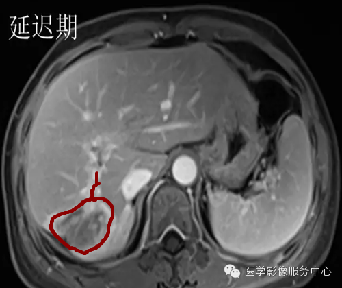 肝脏肿瘤的典型征象—棒棒糖征 肝脏肿瘤的典型征象—棒棒糖征