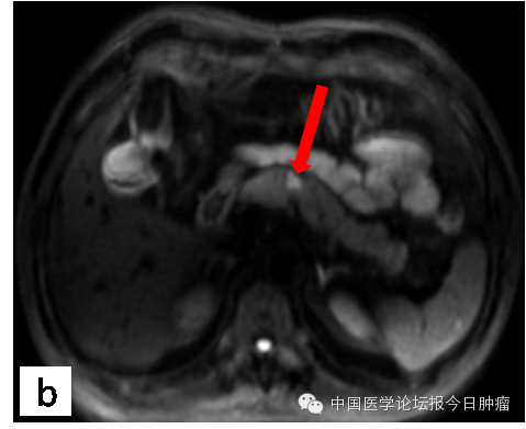 【病例学习】胰腺神经内分泌肿瘤一例MR诊断与鉴别