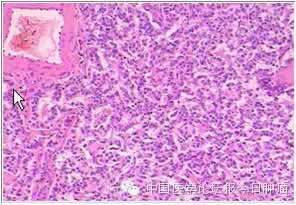 【病例学习】胰腺神经内分泌肿瘤一例MR诊断与鉴别