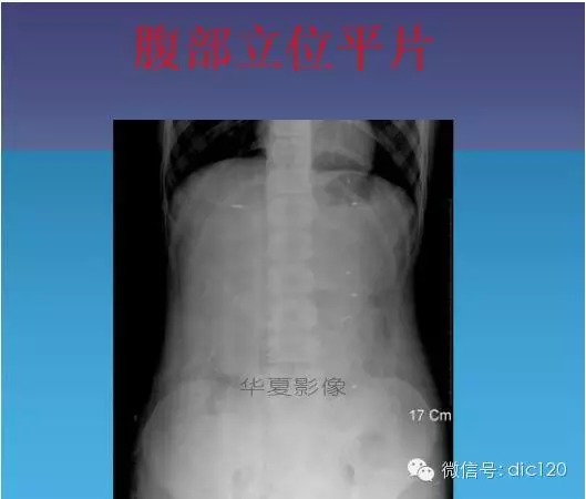 【少见病例】附件扭转所致高度水肿卵巢一例CT诊断与分析 【少见病例】附件扭转所致高度水肿卵巢一例CT诊断与分析