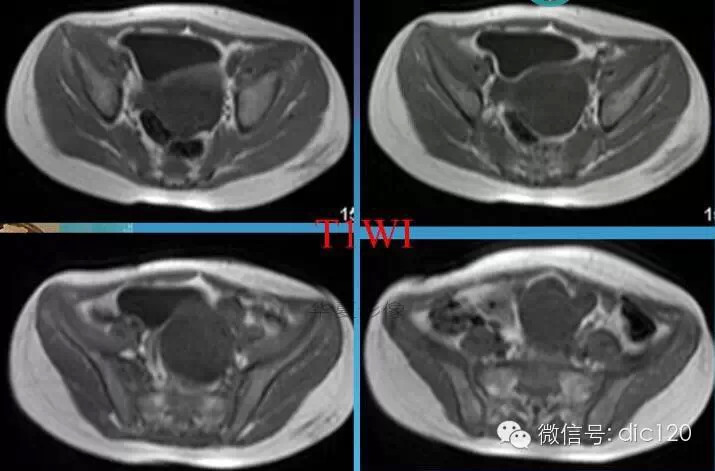 【少见病例】附件扭转所致高度水肿卵巢一例CT诊断与分析 【少见病例】附件扭转所致高度水肿卵巢一例CT诊断与分析