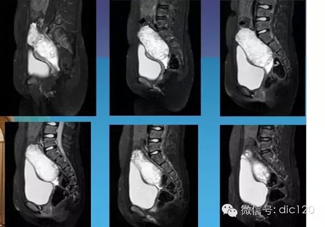 【少见病例】附件扭转所致高度水肿卵巢一例CT诊断与分析 【少见病例】附件扭转所致高度水肿卵巢一例CT诊断与分析