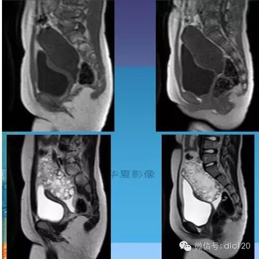 【少见病例】附件扭转所致高度水肿卵巢一例CT诊断与分析 【少见病例】附件扭转所致高度水肿卵巢一例CT诊断与分析