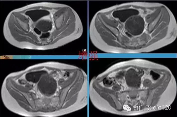 【少见病例】附件扭转所致高度水肿卵巢一例CT诊断与分析 【少见病例】附件扭转所致高度水肿卵巢一例CT诊断与分析