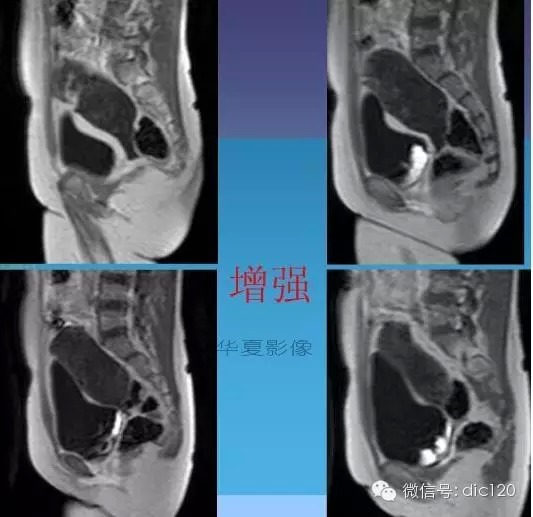 【少见病例】附件扭转所致高度水肿卵巢一例CT诊断与分析 【少见病例】附件扭转所致高度水肿卵巢一例CT诊断与分析