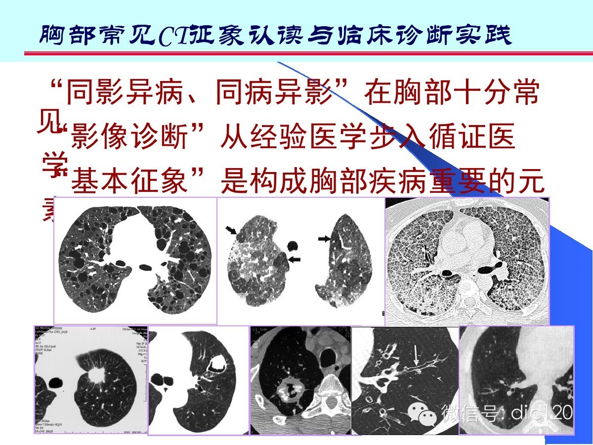 肺部CT十大征象诊断应用