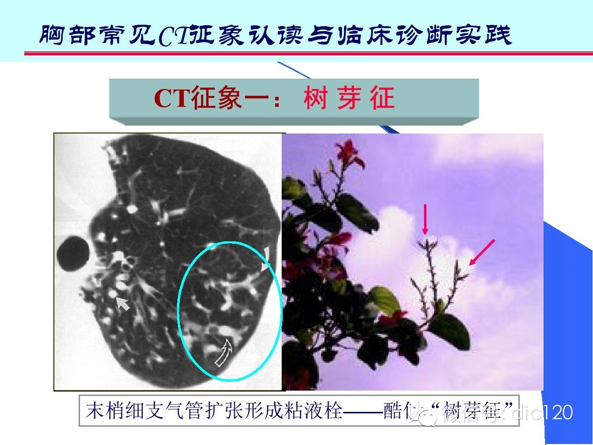 肺部CT十大征象诊断应用