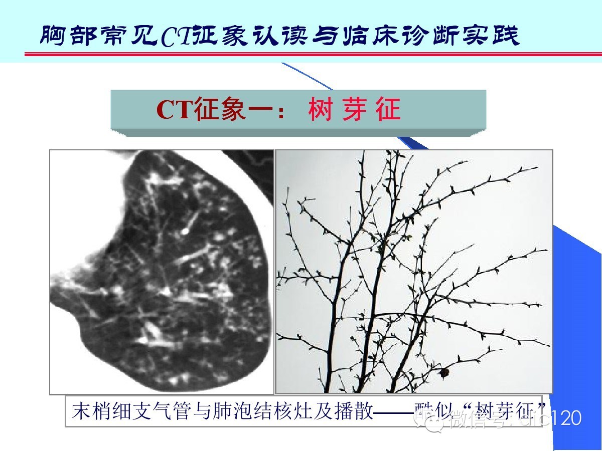 肺部CT十大征象诊断应用
