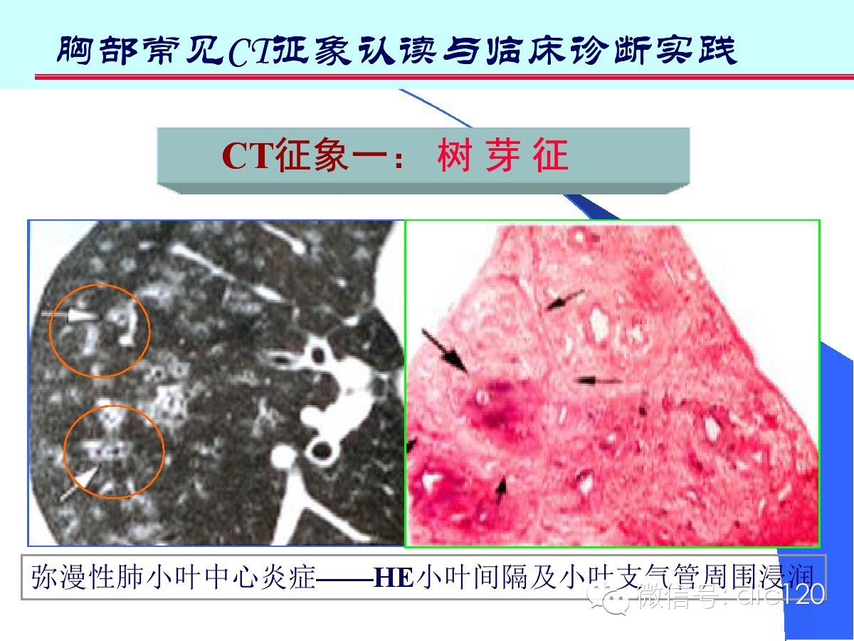 肺部CT十大征象诊断应用
