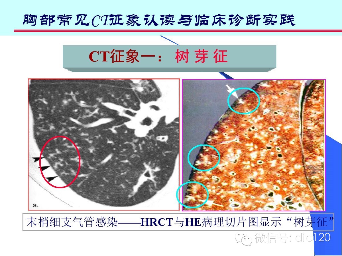 肺部CT十大征象诊断应用