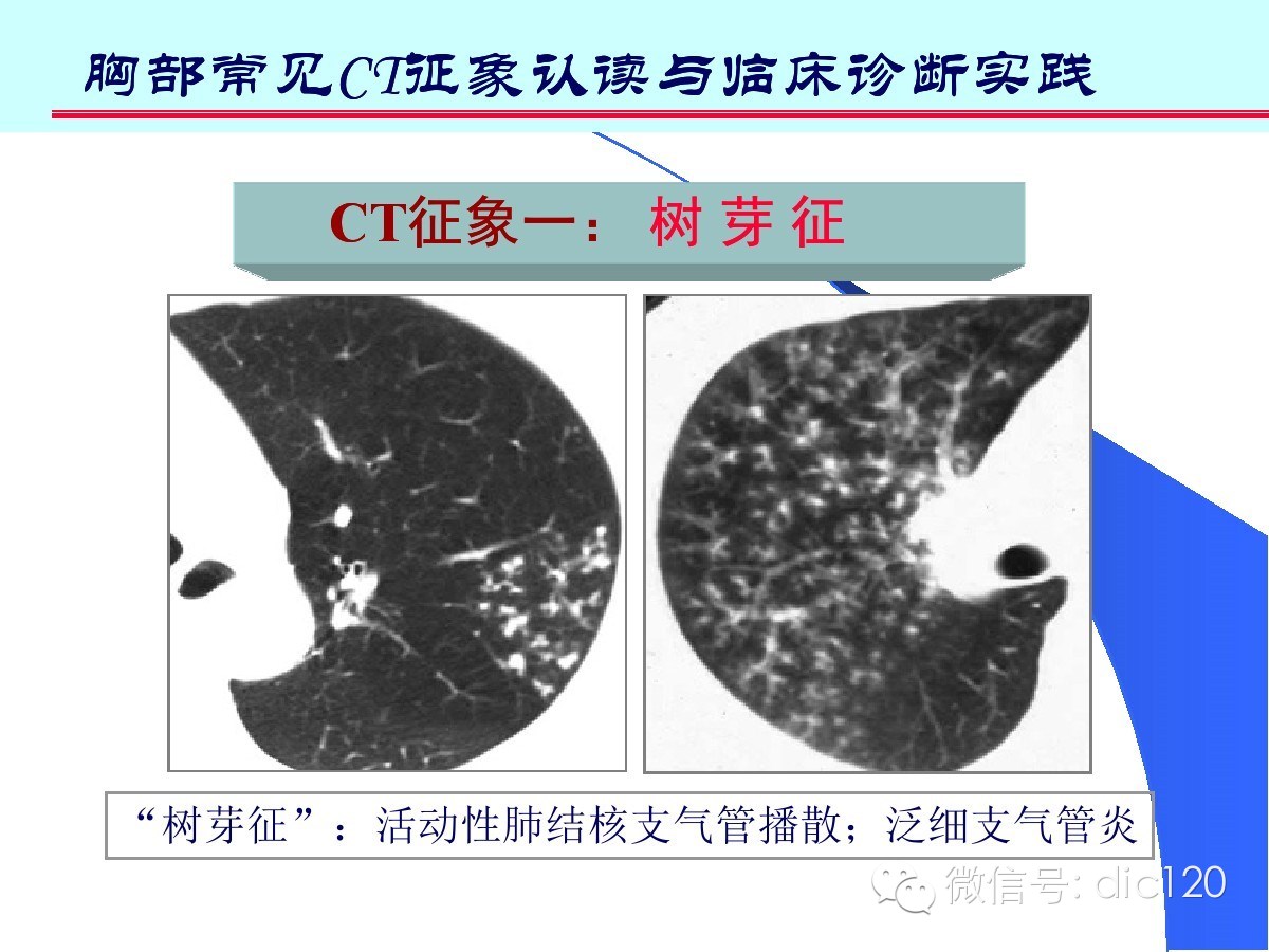 肺部CT十大征象诊断应用