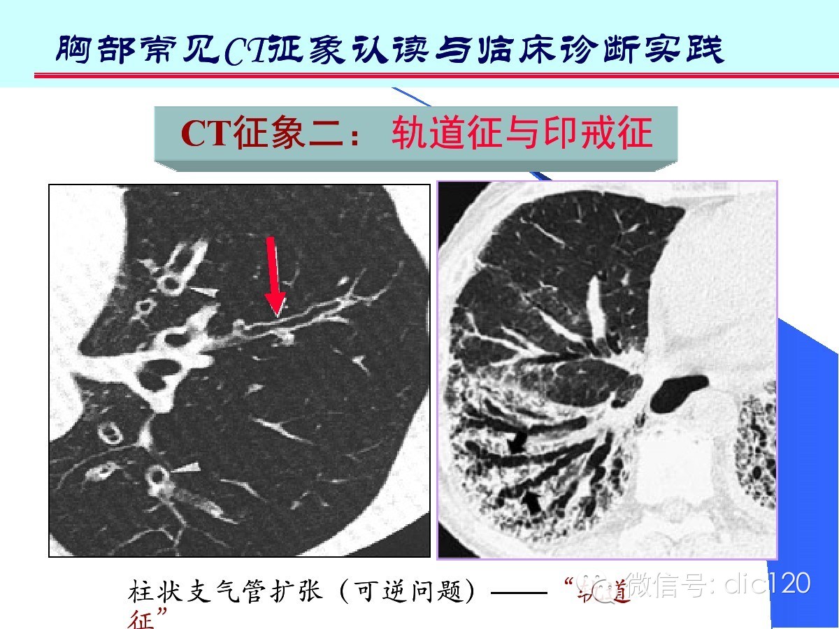 肺部CT十大征象诊断应用