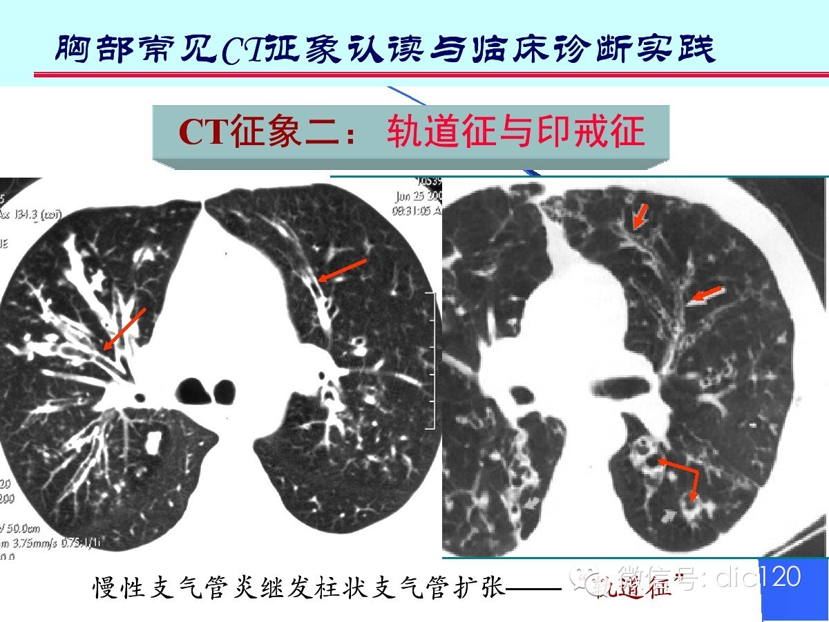 肺部CT十大征象诊断应用
