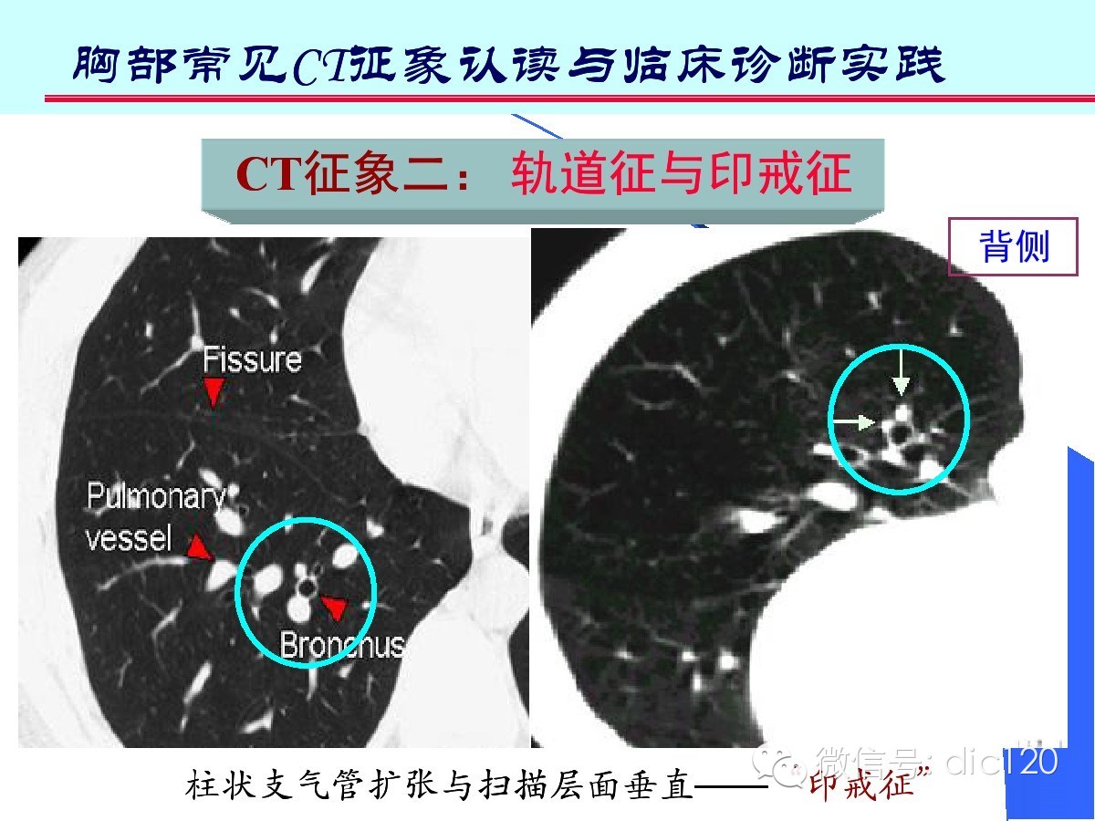 肺部CT十大征象诊断应用