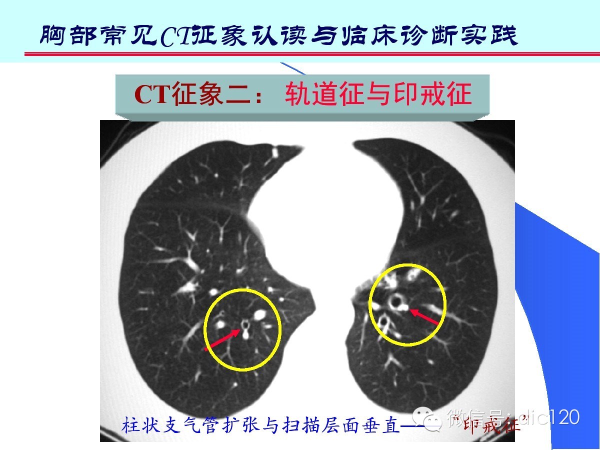 肺部CT十大征象诊断应用