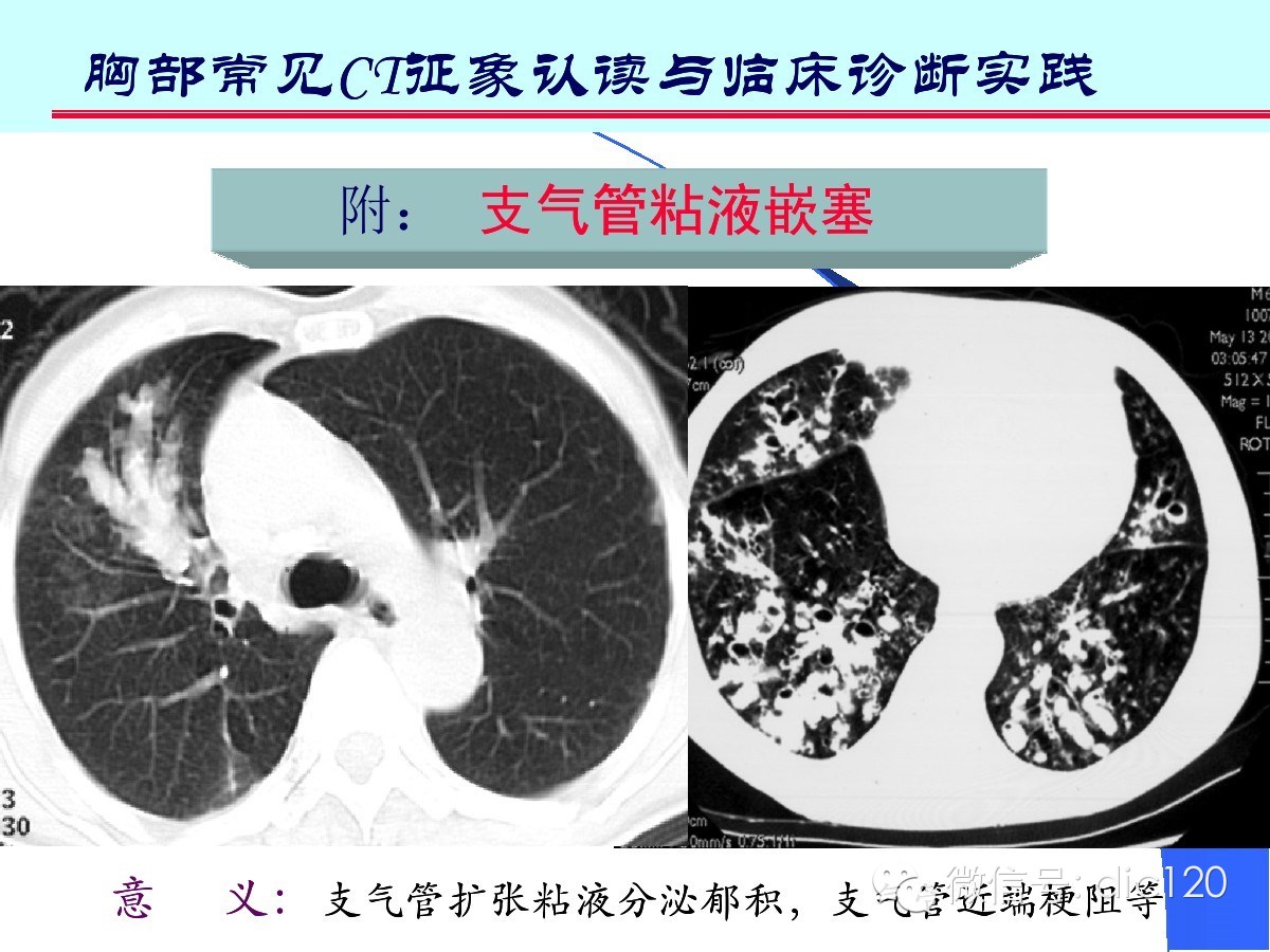 肺部CT十大征象诊断应用