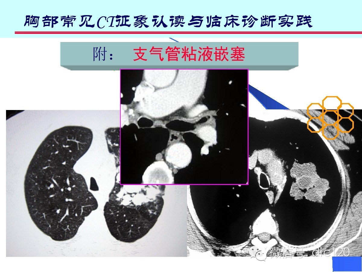 肺部CT十大征象诊断应用