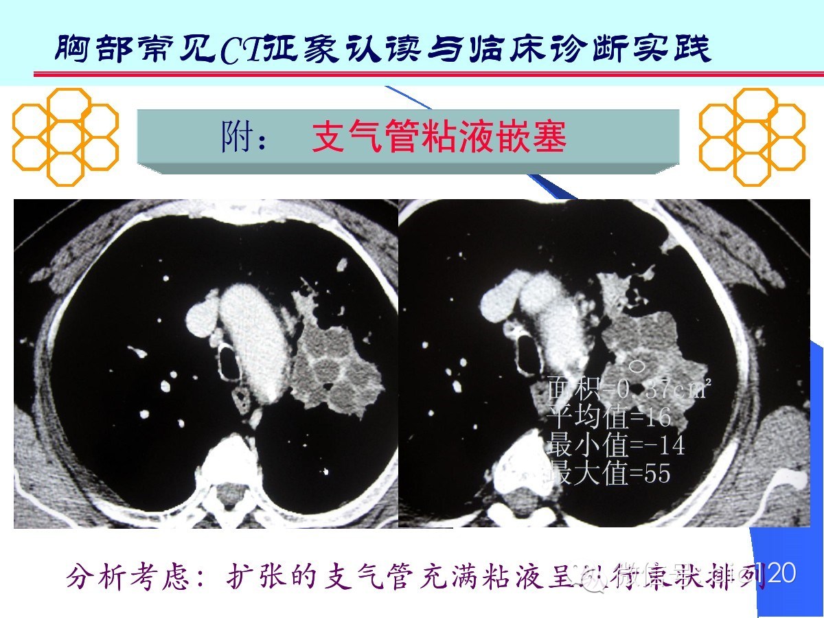 肺部CT十大征象诊断应用