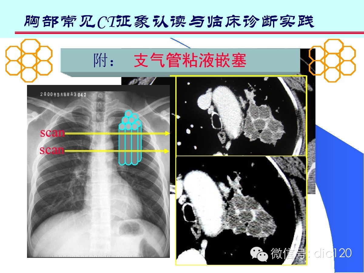 肺部CT十大征象诊断应用