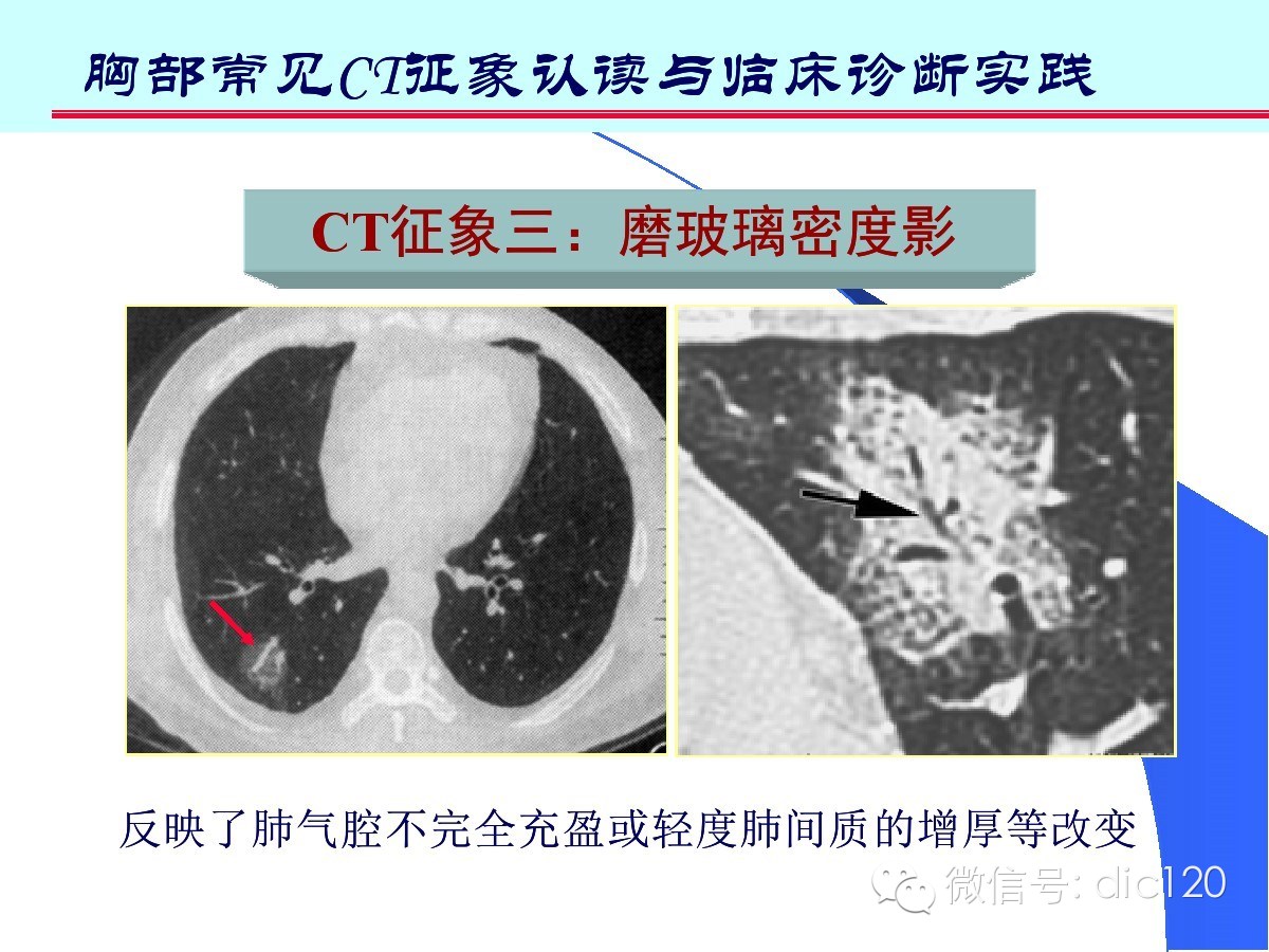 肺部CT十大征象诊断应用