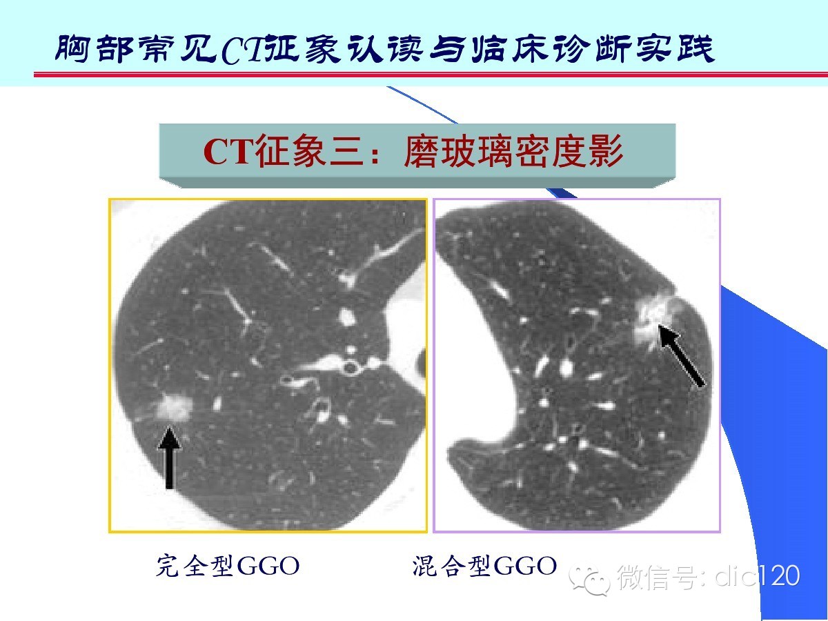 肺部CT十大征象诊断应用