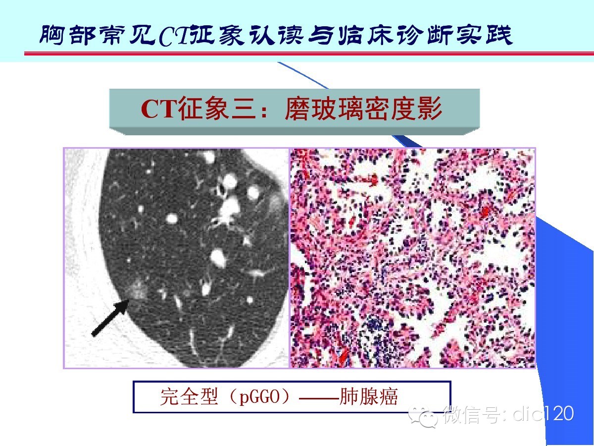 肺部CT十大征象诊断应用