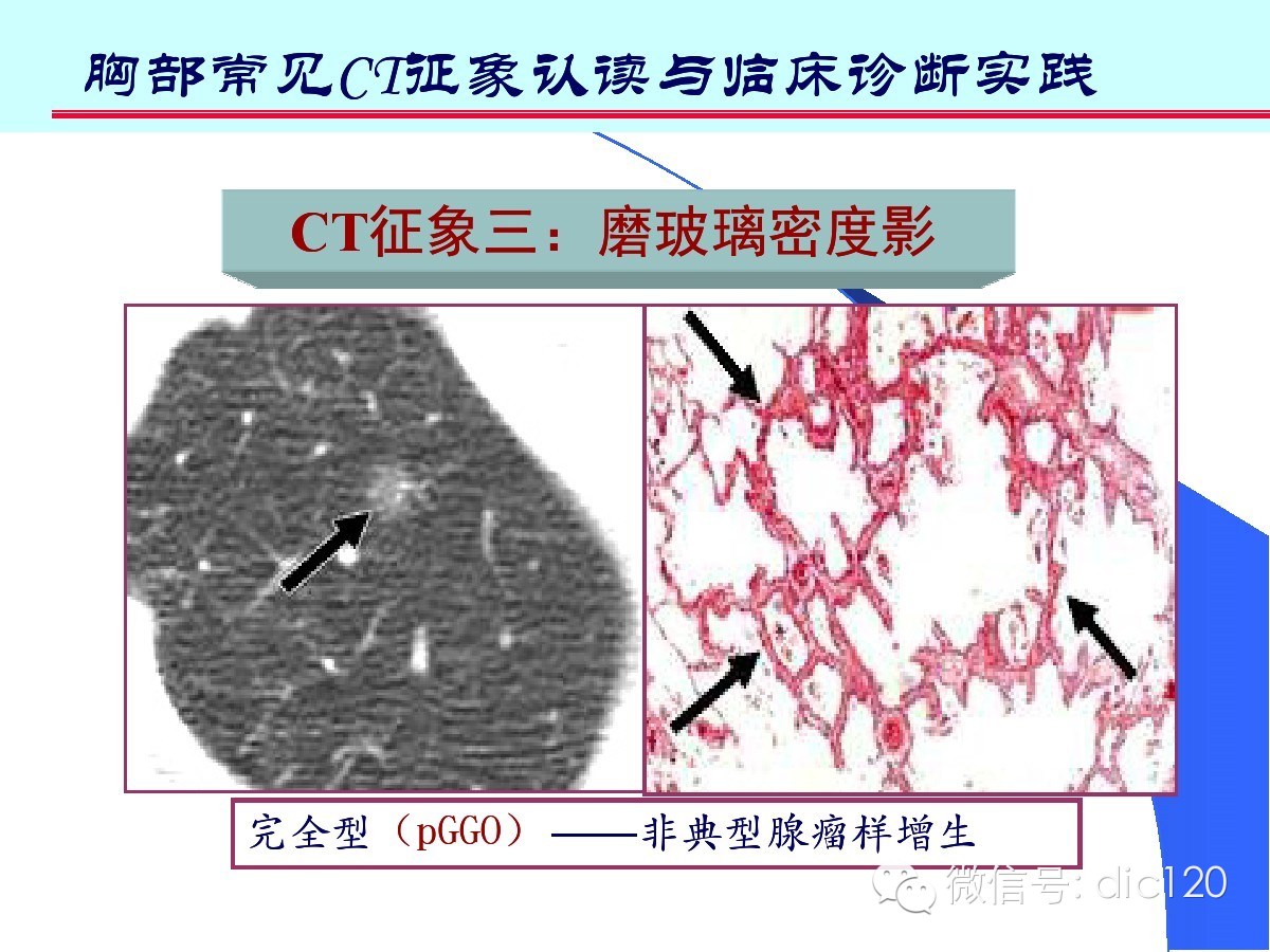 肺部CT十大征象诊断应用