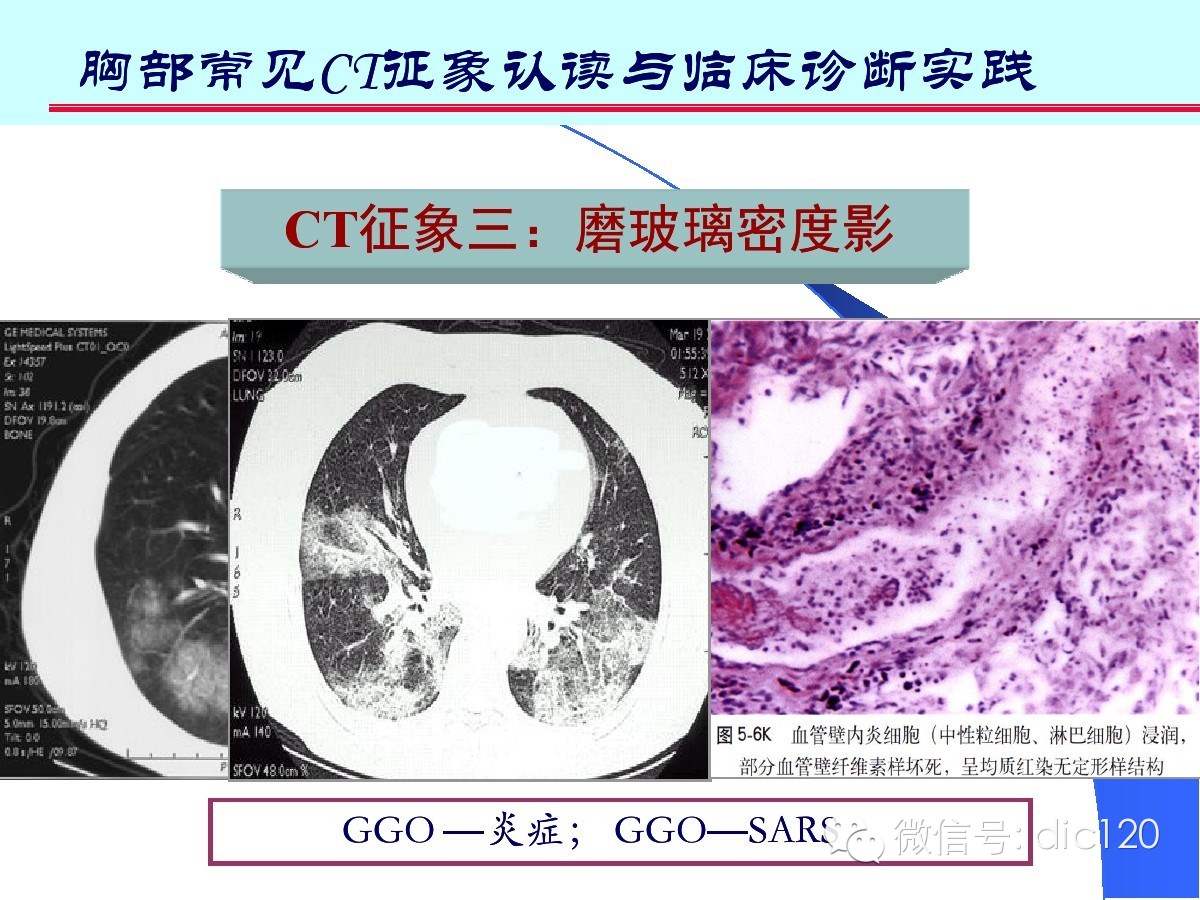 肺部CT十大征象诊断应用