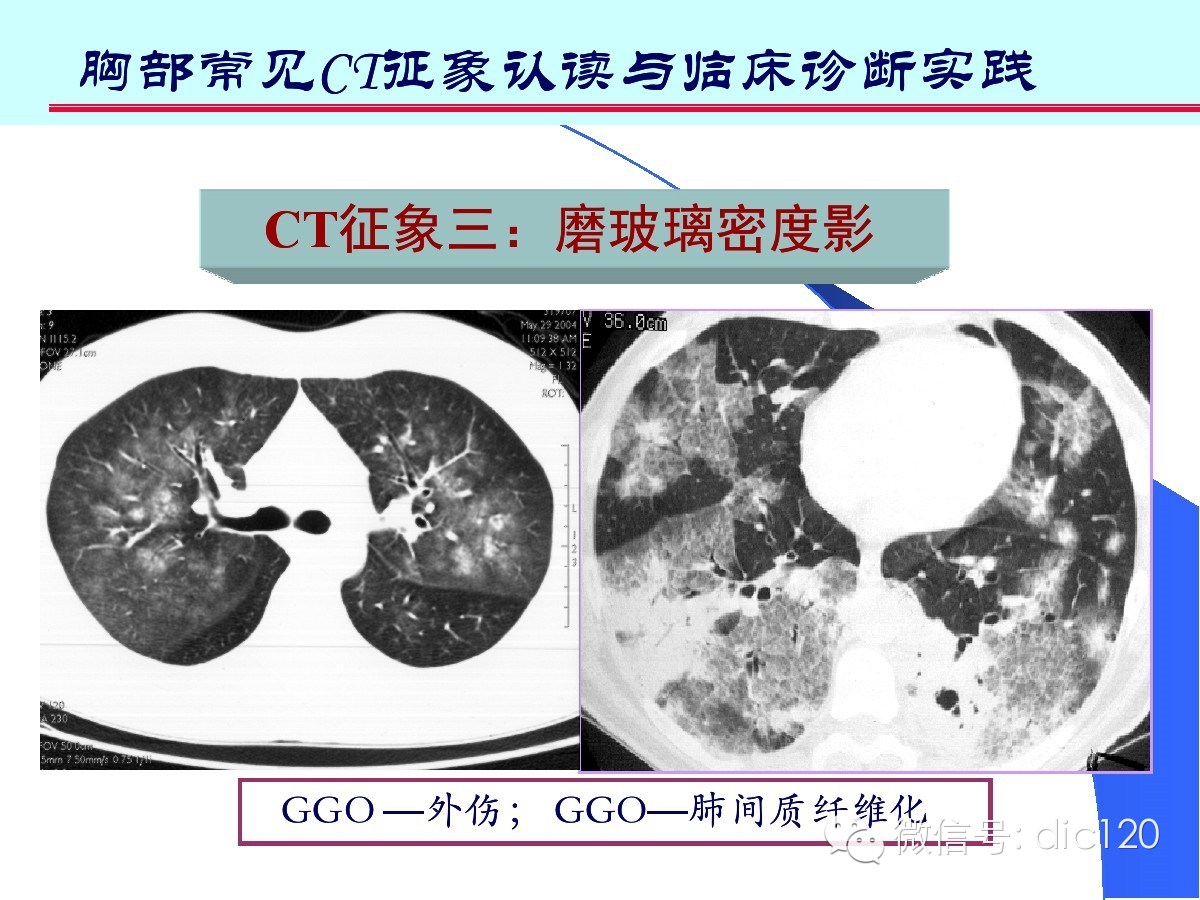 肺部CT十大征象诊断应用