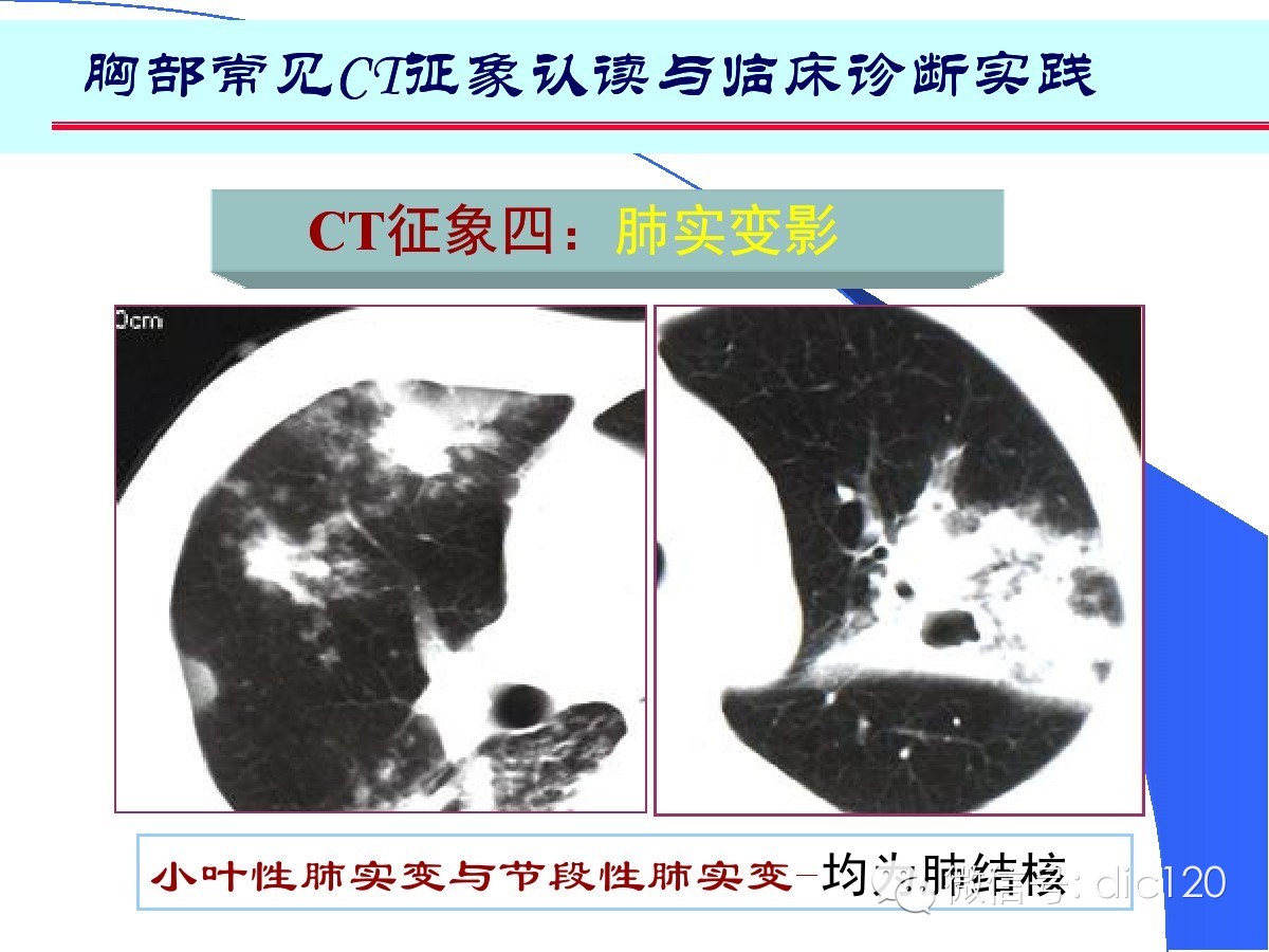 肺部CT十大征象诊断应用